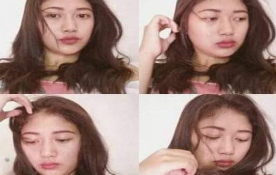 Gadis yang dibakar kekasih di Cianjur (Foto: dok.pribadi)